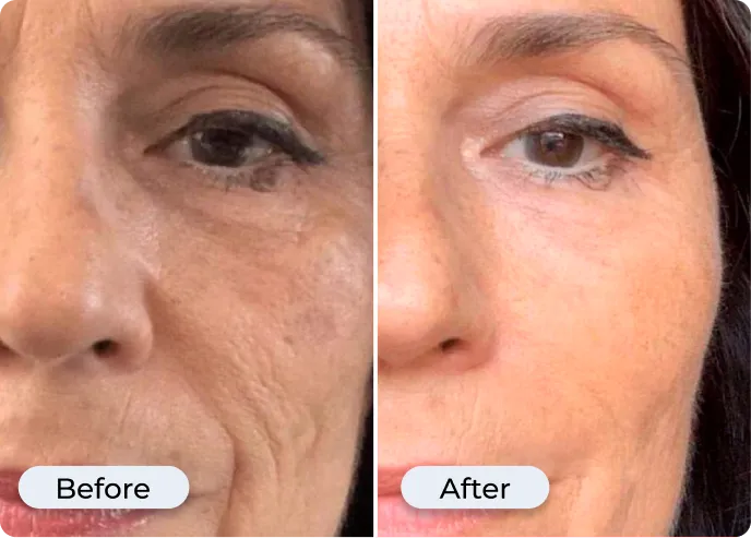 Michelle — before and after, 1 month